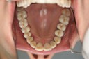 dr Mosna circ. zirconia lava 1 - 2.jpg