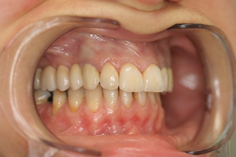 dr Mosna circ. zirconia lava 1 - 5.jpg